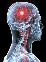 Stroke pic
